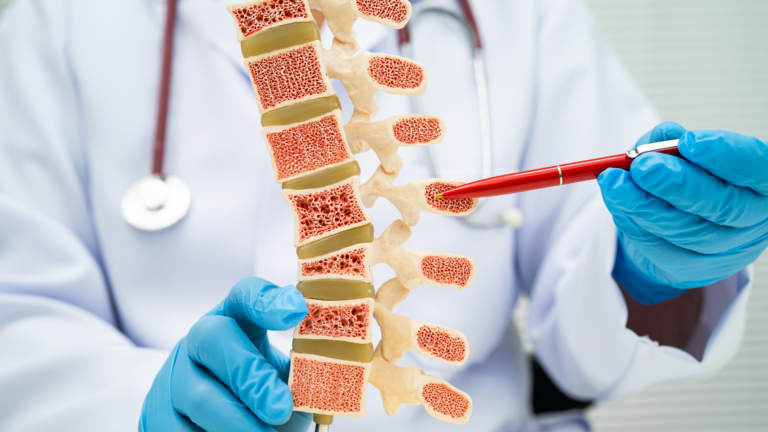 Osteoporosis screening feature image